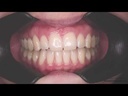 Retractor Labial 201 Lateral Natural "V" Grande X 2u autoclavables. FOTODENTAL